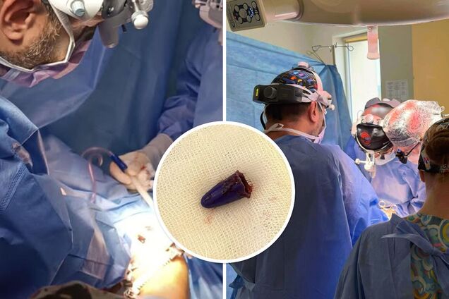 У Львові дівчинка випадково вдихнула ковпачок від ручки й ледь не задихнулася: лікарі провели складну операцію. Фото