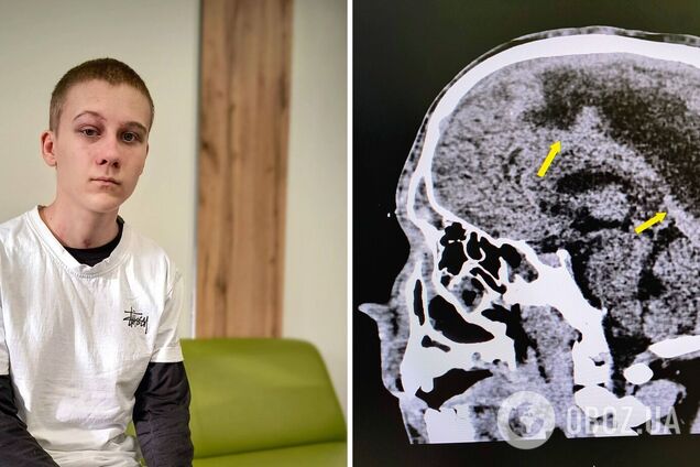 Впал в кому на следующий день после 16-летия: во Львове спасли подростка, который едва не погиб из-за гноя в мозге