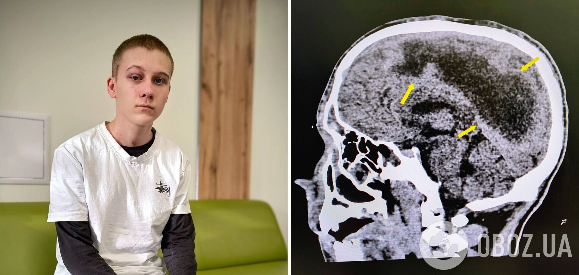 Впал в кому на следующий день после 16-летия: во Львове спасли подростка, который едва не погиб из-за гноя в мозге