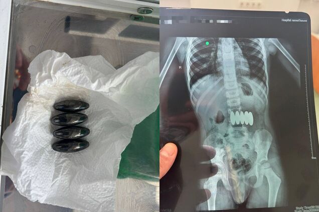 'Небезпечна іграшка': у Черкасах медики врятували дитину, яка проковтнула п'ять магнітів. Фото