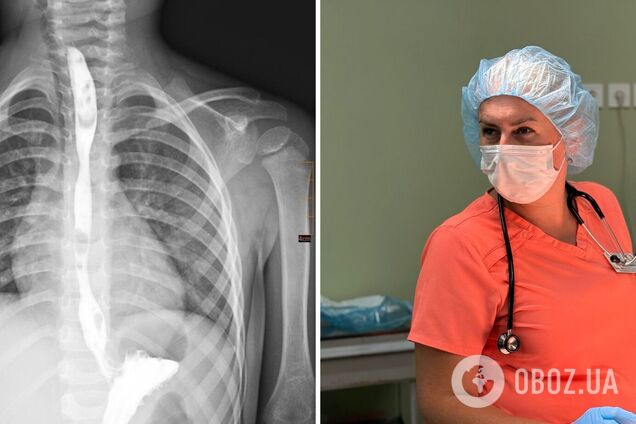 Лікування тривало два роки: у Львові врятували трирічну дитину, яка випила засіб для видалення жиру