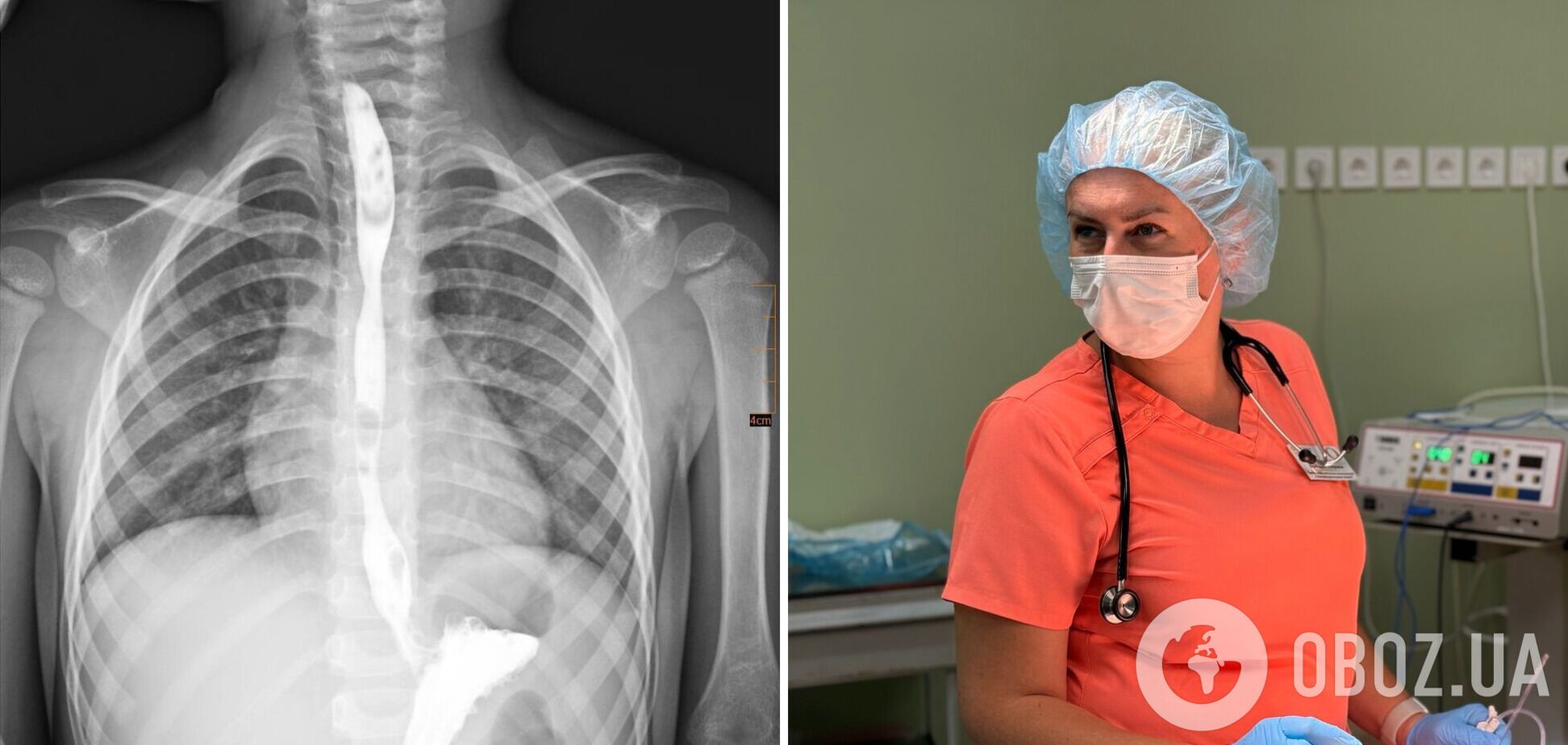 Лікування тривало два роки: у Львові врятували трирічну дитину, яка випила засіб для видалення жиру