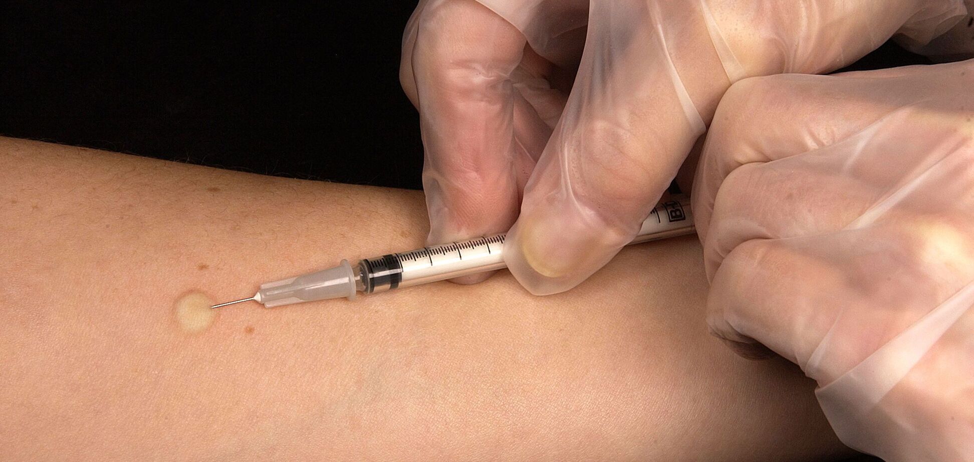 Проб Манту не будет? В Украине анонсировали переход на новые методы выявления туберкулеза