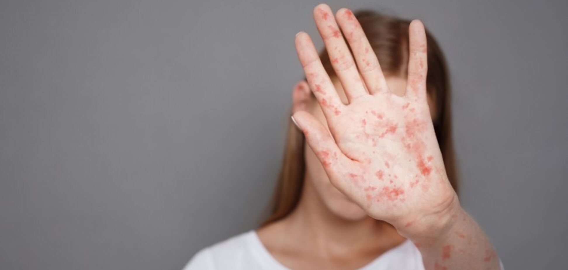 В одном из регионов Украины ликвидировали пять вспышек кори: более 80% случаев болели дети