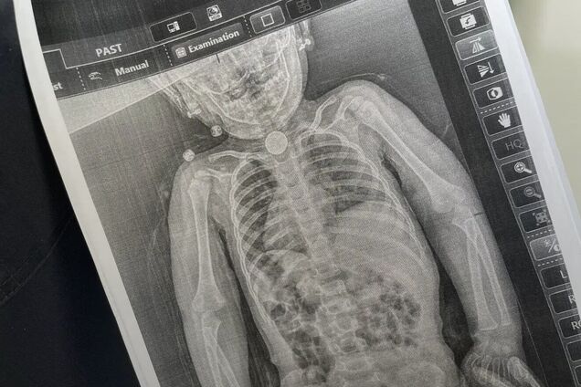 Мучилася від болю: у Львові медики врятували дворічну дівчинку, яка три місяці жила з літієвою батарейкою у стравоході. Фото