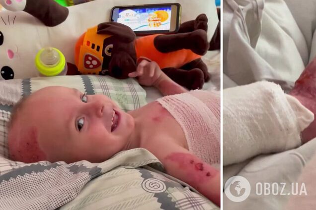 'Шансів майже не було': у Львові врятували 3-річного хлопчика із опіками 70% площі тіла. Відео
