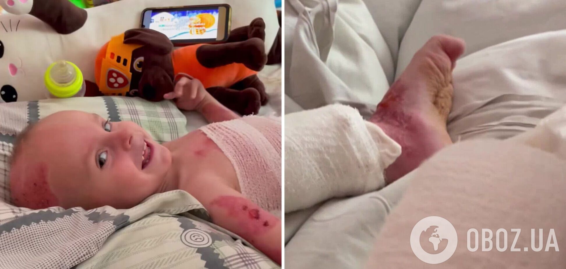 'Шансів майже не було': у Львові врятували 3-річного хлопчика із опіками 70% площі тіла. Відео