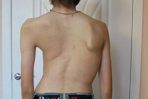Деформация позвоночника