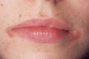 Трещины в уголках рта