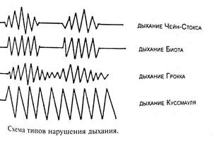 Дыхание Куссмауля